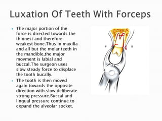  The major portion of the
force is directed towards the
thinnest and therefore
weakest bone.Thus in maxilla
and all but the molar teeth in
the mandible,the major
movment is labial and
buccal.The surgeon uses
slow steady force to displace
the tooth bucally.
 The tooth is then moved
again towards the opposite
direction with slow deliberate
strong pressure.Buccal and
lingual pressure continue to
expand the alveolar socket.
 