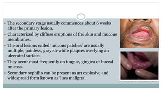 Actinomycosis, Tetanus, Syphilis.pptx