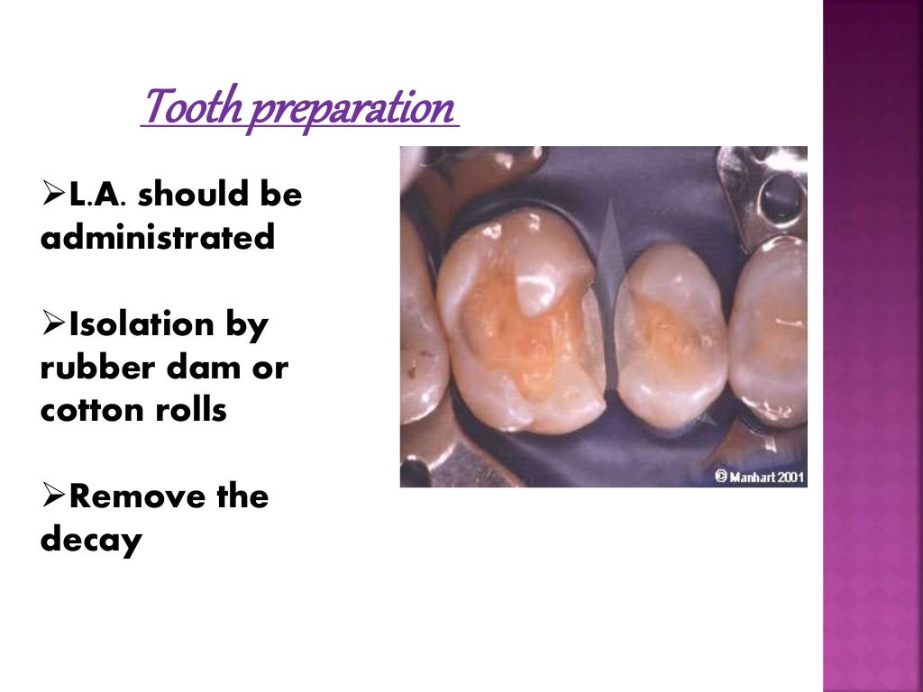 Stainless Steel Crown