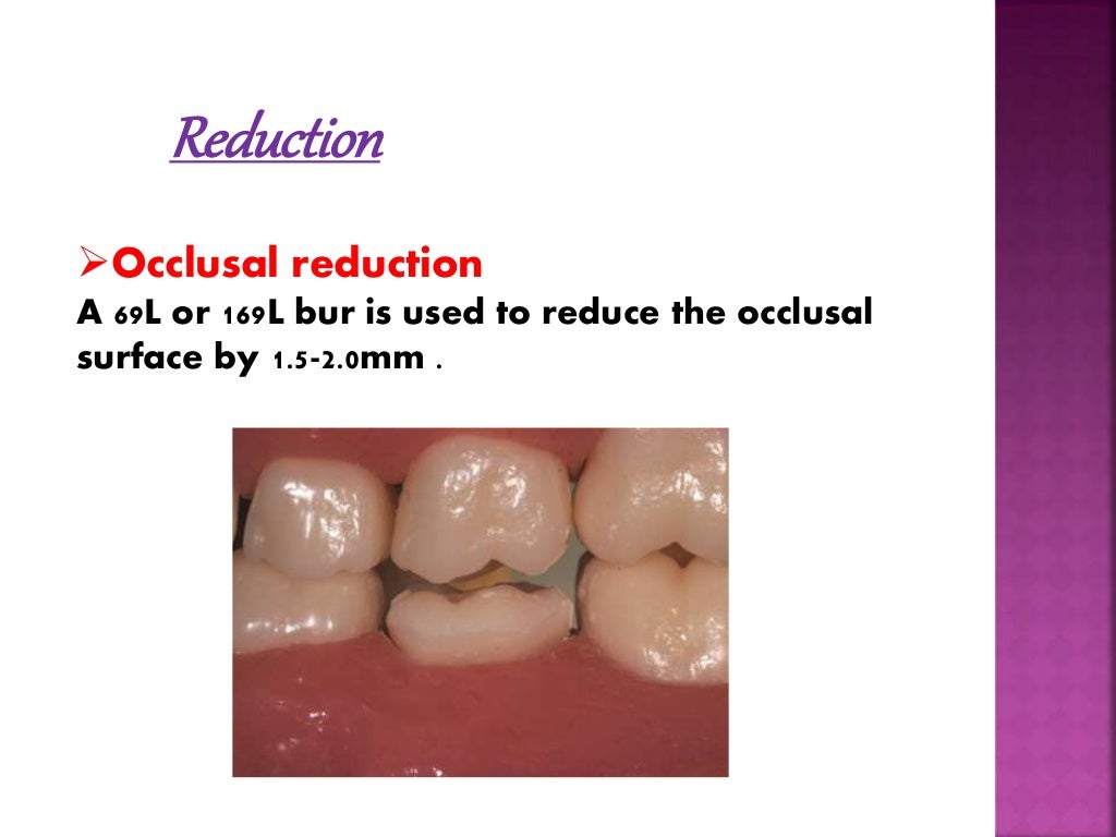 Stainless Steel Crown