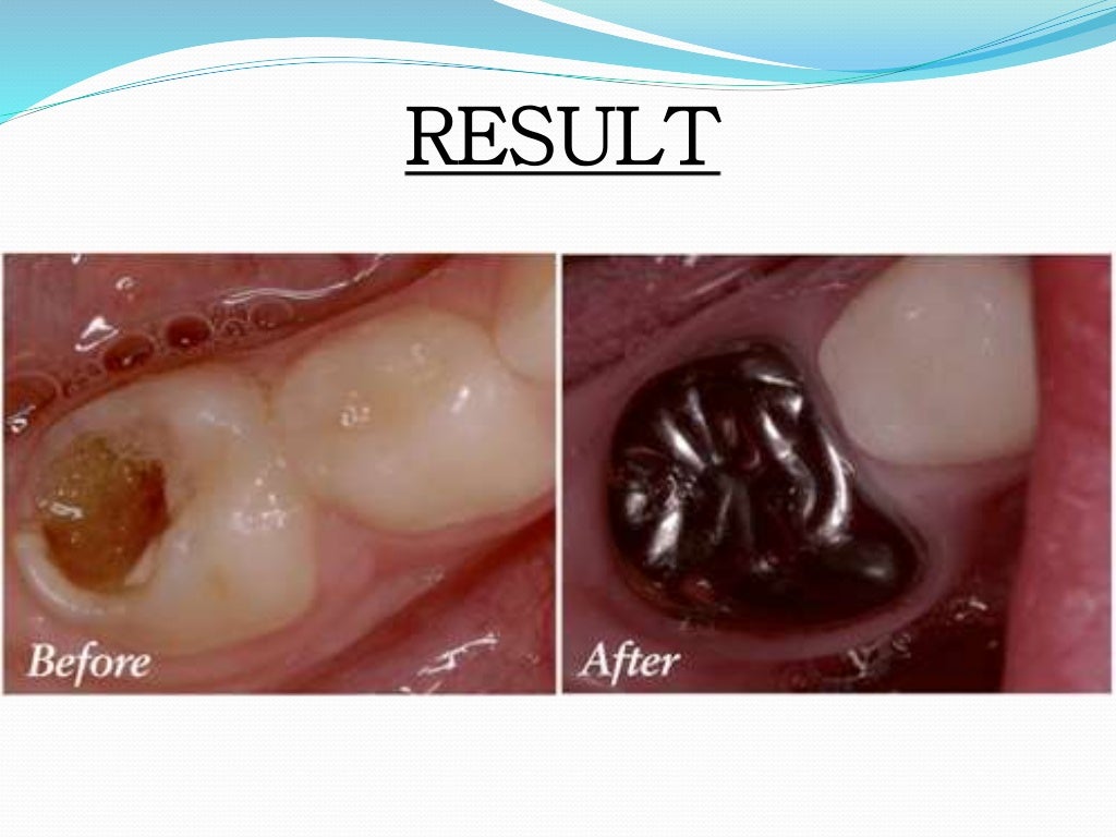 Stainless Steel Crown (Department of pedodontics)