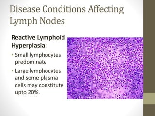 Disease Conditions Affecting
Lymph Nodes
Reactive Lymphoid
Hyperplasia:
• Small lymphocytes
predominate
• Large lymphocytes
and some plasma
cells may constitute
upto 20%.
 