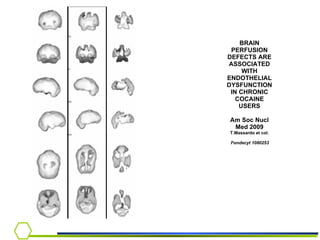 BRAIN PERFUSION DEFECTS ARE ASSOCIATED WITH ENDOTHELIAL DYSFUNCTION IN CHRONIC COCAINE USERS Am Soc Nucl Med 2009 T.Massardo et col.   Fondecyt 1080253 