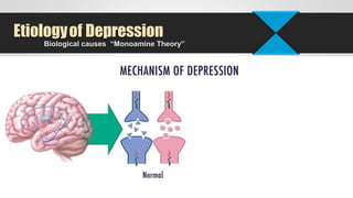 Biological causes “Monoamine Theory”
Etiologyof Depression
 