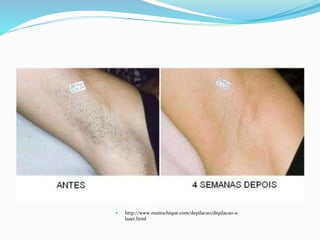  http://www.muitochique.com/depilacao/depilacao-a-
laser.html
 