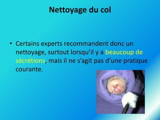 Nettoyage du col

• Certains experts recommandent donc un
nettoyage, surtout lorsqu’il y a beaucoup de
sécrétions, mais il ne s’agit pas d’une pratique
courante.

 