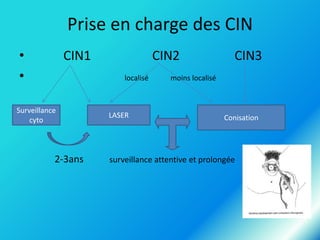 Prise en charge des CIN
•
•

CIN1

CIN2
localisé

Surveillance
cyto

2-3ans

LASER

CIN3

moins localisé

Conisation

surveillance attentive et prolongée

 