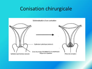 Conisation chirurgicale

 