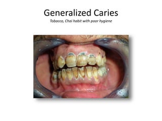 Generalized Caries 
Tobacco, Chai habit with poor hygiene 
 