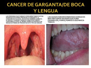 LAS PERSONAS QUE FUMAN O CONSUMEN TABACO ESTÁN
EN RIESGO DE SUFRIR CÁNCER EN LA GARGANTA. EL      LAS CAUSAS SON DESCONOCIDAS AUNQUE ES
CONSUMO DE ALCOHOL EN EXCESO TAMBIÉN AUMENTA       MÁS FRECUENTE EN GENTE QUE FUMA
EL RIESGO Y QUIENES TIENEN EL HÁBITO DE FUMAR Y    CIGARRILLOS, PUROS,PORROS O QUE MASCA
CONSUMIR ALCOHOL AL MISMO TIEMPO ESTÁN BAJO UN     TABACO.
RIESGO EXTREMO DE PRESENTAR ESTE TIPO DE CÁNCER.
 