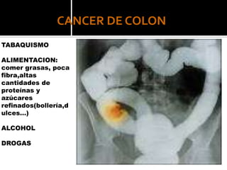 CANCER DE COLON
TABAQUISMO

ALIMENTACION:
comer grasas, poca
fibra,altas
cantidades de
proteínas y
azúcares
refinados(bollería,d
ulces…)

ALCOHOL

DROGAS
 
