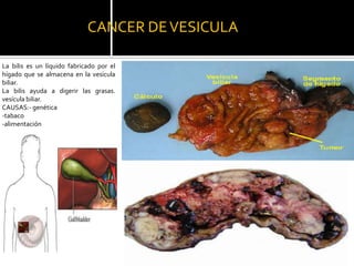 CANCER DE VESICULA

La bilis es un líquido fabricado por el
hígado que se almacena en la vesícula
biliar.
La bilis ayuda a digerir las grasas.
vesícula biliar.
CAUSAS:- genética
-tabaco
-alimentación
 