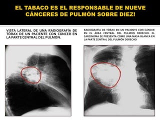 VISTA LATERAL DE UNA RADIOGRAFÍA DE   RADIOGRAFÍA DE TÓRAX EN UN PACIENTE CON CÁNCER
TÓRAX DE UN PACIENTE CON CÁNCER EN    EN EL ÁREA CENTRAL DEL PULMÓN DERECHO. EL
LA PARTE CENTRAL DEL PULMÓN.          CARCINOMA SE PRESENTA COMO UNA MASA BLANCA EN
                                      LA PARTE CENTRAL DEL PULMÓN DERECHO
 