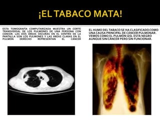 ESTA TOMOGRAFÍA COMPUTARIZADA MUESTRA UN CORTE       EL HUMO DEL TABACO SE HA CLASIFICADO COMO
TRANSVERSAL DE LOS PULMONES DE UNA PERSONA CON
CÁNCER. LAS DOS ÁREAS OSCURAS EN EL CENTRO DE LA     UNA CAUSA PRINCIPAL DE CÁNCER PULMONAR.
PANTALLA SON LOS PULMONES Y LAS ÁREAS CLARAS EN EL   VEMOS COMO EL PULMÓN IZQ. ESTÁ NEGRO
PULMÓN     DERECHO    REPRESENTAN    EL    CÁNCER    AUNQUE SIN CÁNCER PERO SIN FUNCIONAR.
 