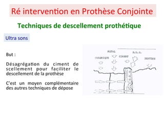 Ré interven+on en Prothèse Conjointe
Ultra sons
Techniques de descellement prothé;que
But :
Désagréga+on du ciment de
scellement pour faciliter le
descellement de la prothèse
C’est un moyen complémentaire
des autres techniques de dépose
 