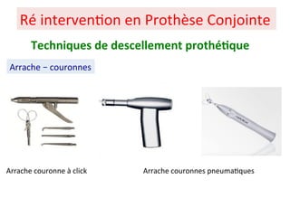 Ré interven+on en Prothèse Conjointe
Arrache – couronnes
Techniques de descellement prothé;que
Arrache couronne à click Arrache couronnes pneuma+ques
 