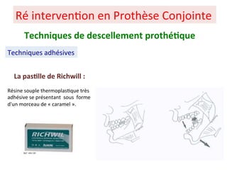 Ré interven+on en Prothèse Conjointe
Techniques adhésives
Techniques de descellement prothé;que
La pas;lle de Richwill :
Résine souple thermoplas+que très
adhésive se présentant sous forme
d'un morceau de « caramel ».
 