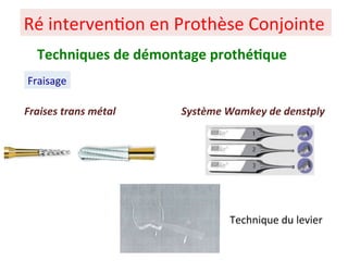 Ré interven+on en Prothèse Conjointe
Fraisage
Techniques de démontage prothé;que
Fraises trans métal Système Wamkey de denstply
Technique du levier
 