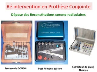 Ré interven+on en Prothèse Conjointe
Dépose des Recons;tu;ons corono-radiculaires
Trousse de GONON
Extracteur de pivot
Thomas
Post Removal system
 