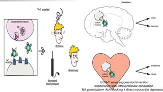 ECG-T wave suppression/inversion
interference with intraventricular conduction
NA potentiation+ Ach blocking + direct myocardial depressio
 