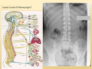Laurie Cured of Fibromyalgia!!
 