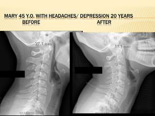 MARY 45 Y.O. WITH HEADACHES/ DEPRESSION 20 YEARS
BEFORE AFTER
 