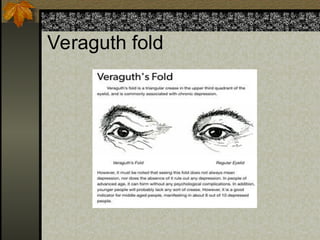 Veraguth fold
 