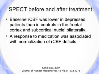 SPECT before and after treatment
• Baseline rCBF was lower in depressed
  patients than in controls in the frontal
  cortex and subcortical nuclei bilaterally.
• A response to medication was associated
  with normalization of rCBF deficits,




                          Kohn et al, 2007
        Journal of Nuclear Medicine Vol. 48 No. 8 1273-1278
 