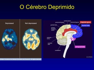 O Cérebro Deprimido 