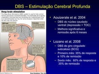 DBS – Estimulação Cerebral Profunda  Aouizerate et al. 2004 DBS do núcleo caudado ventral (depressão + TOC) Melhora significativa e remissão após 6 meses Lozano et al. 2008 DBS do giro cingulado subcaloso (SCG) Primeiro mês: 35% de resposta e 10% de remissão Sexto mês:  60% de resposta e  35% de remissão 