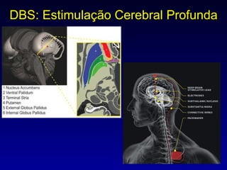 DBS: Estimulação Cerebral Profunda 