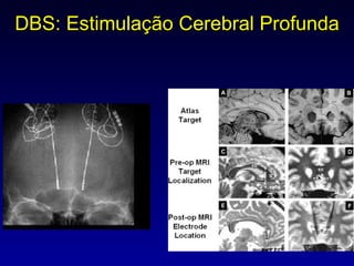 DBS: Estimulação Cerebral Profunda 