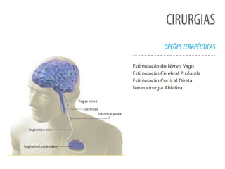 CIRURGIAS
OPÇÕESTERAPÊUTICAS
Estimulação do Nervo Vago
Estimulação Cerebral Profunda
Estimulação Cortical Direta
Neurocirurgia Ablativa
 