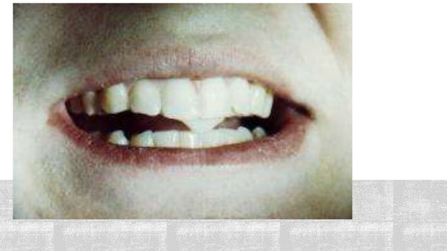 Deprogramming spilnt 1 | PPTX | Dental Health | Diseases and Conditions