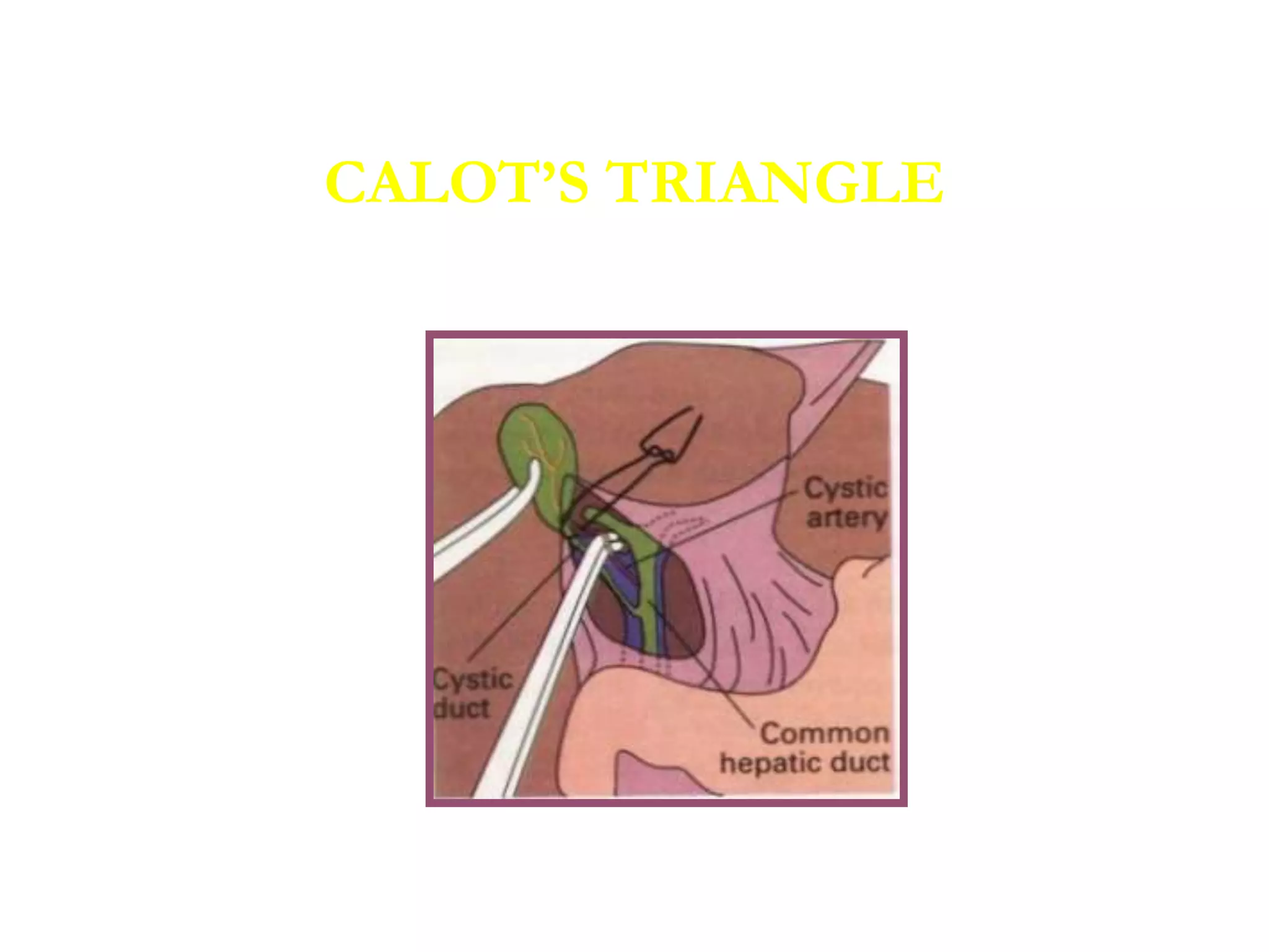 CALOT’S TRIANGLE
 