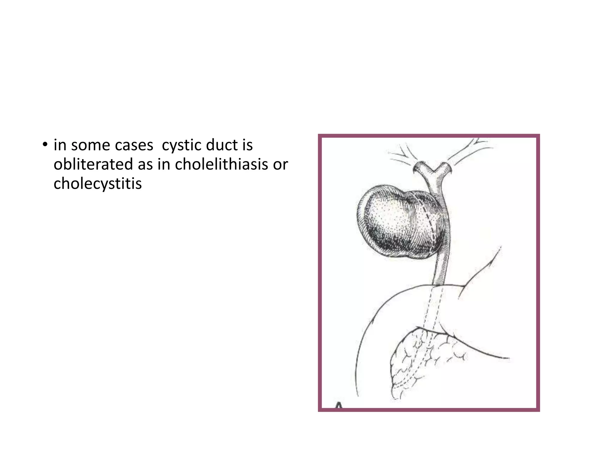 • in some cases cystic duct is
obliterated as in cholelithiasis or
cholecystitis
 