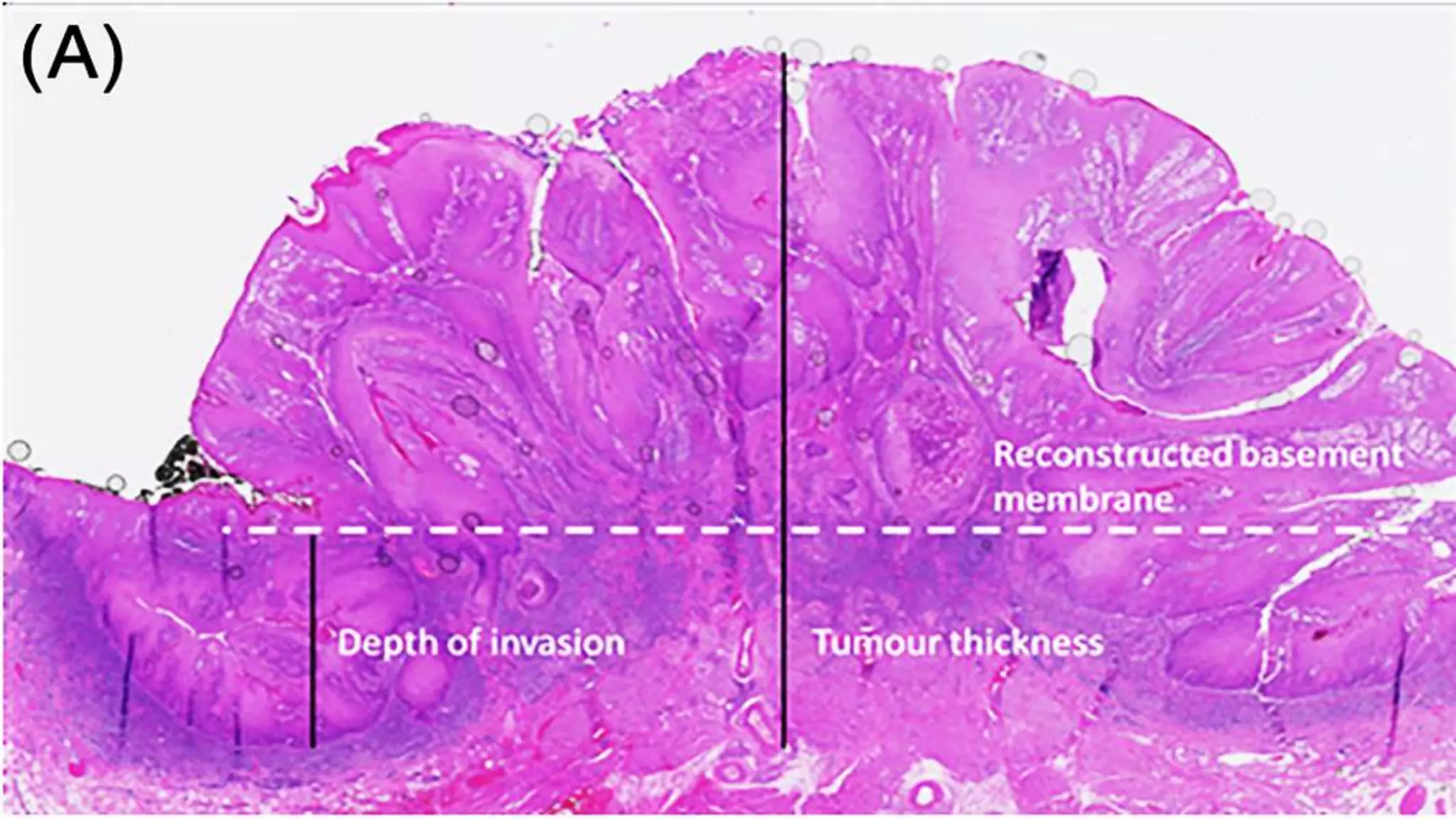 Depth of invasion in oral squamous cell carcinoma | PPTX