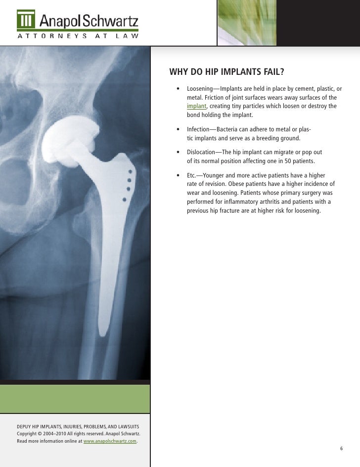 DePuy Hip Implant Recall Lawsuits