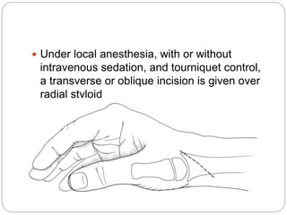  Under local anesthesia, with or without
intravenous sedation, and tourniquet control,
a transverse or oblique incision is given over
radial styloid
 