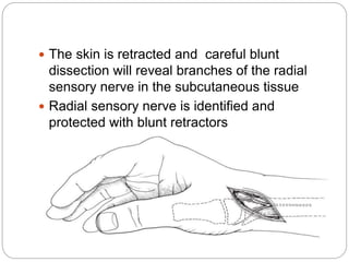  The skin is retracted and careful blunt
dissection will reveal branches of the radial
sensory nerve in the subcutaneous tissue
 Radial sensory nerve is identified and
protected with blunt retractors
 