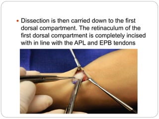  Dissection is then carried down to the first
dorsal compartment. The retinaculum of the
first dorsal compartment is completely incised
with in line with the APL and EPB tendons
 