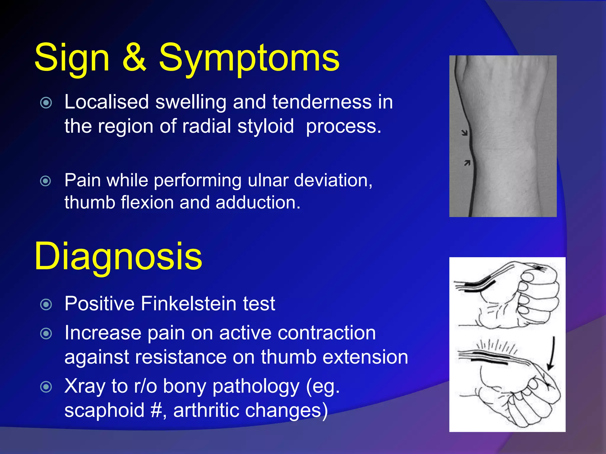 De quervain's | PPTX