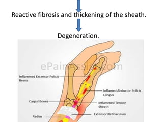 Reactive fibrosis and thickening of the sheath.
Degeneration.
 