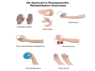 De Quervain s PPT De Quervain s PPT