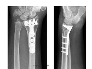 DISTAL END RADIUS FRACTURE | PPTX