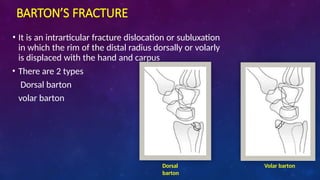 Barton Type distal end radius fracture and its management | PPTX