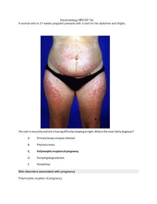 Deramatology MRCGP Qs
A woman who is 31 weeks pregnant presents with a rash on her abdomen and thighs:
The rash is veryitchyand she ishavingdifficultysleepingatnight.Whatis the most likelydiagnosis?
A. Primaryherpessimplex infection
B. Pityriasisrosea
C. Polymorphiceruptionof pregnancy
D. Pemphigoidgestationis
E. Pompholyx
Skin disorders associated with pregnancy
Polymorphic eruption of pregnancy
 