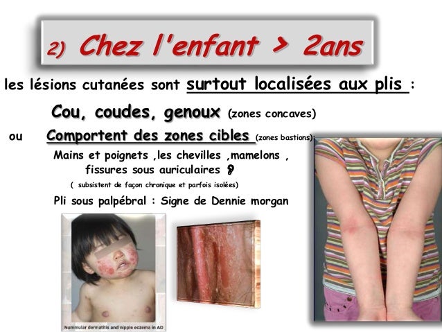 Comme traiter le psoriasis par le peroxyde