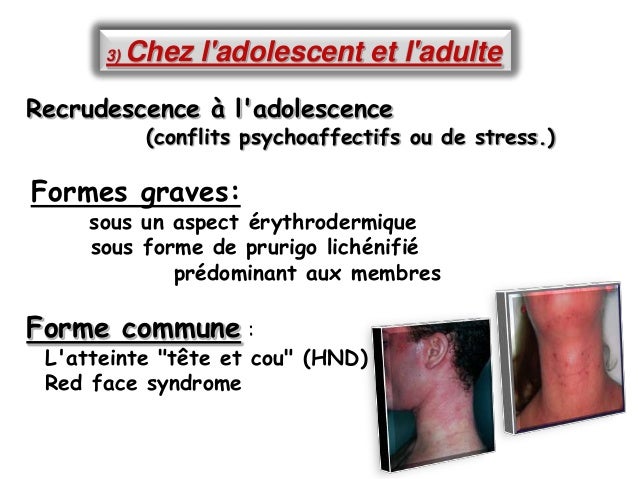 Le tableau que peut et on ne peut pas au psoriasis le tableau