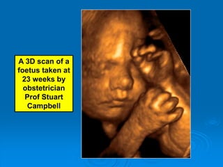 A 3D scan of a
foetus taken at
 23 weeks by
  obstetrician
  Prof Stuart
   Campbell
 